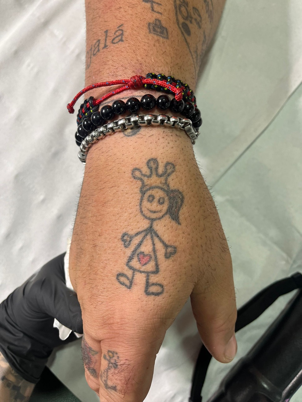 Tatuaje en la mano antes de la eliminación láser
