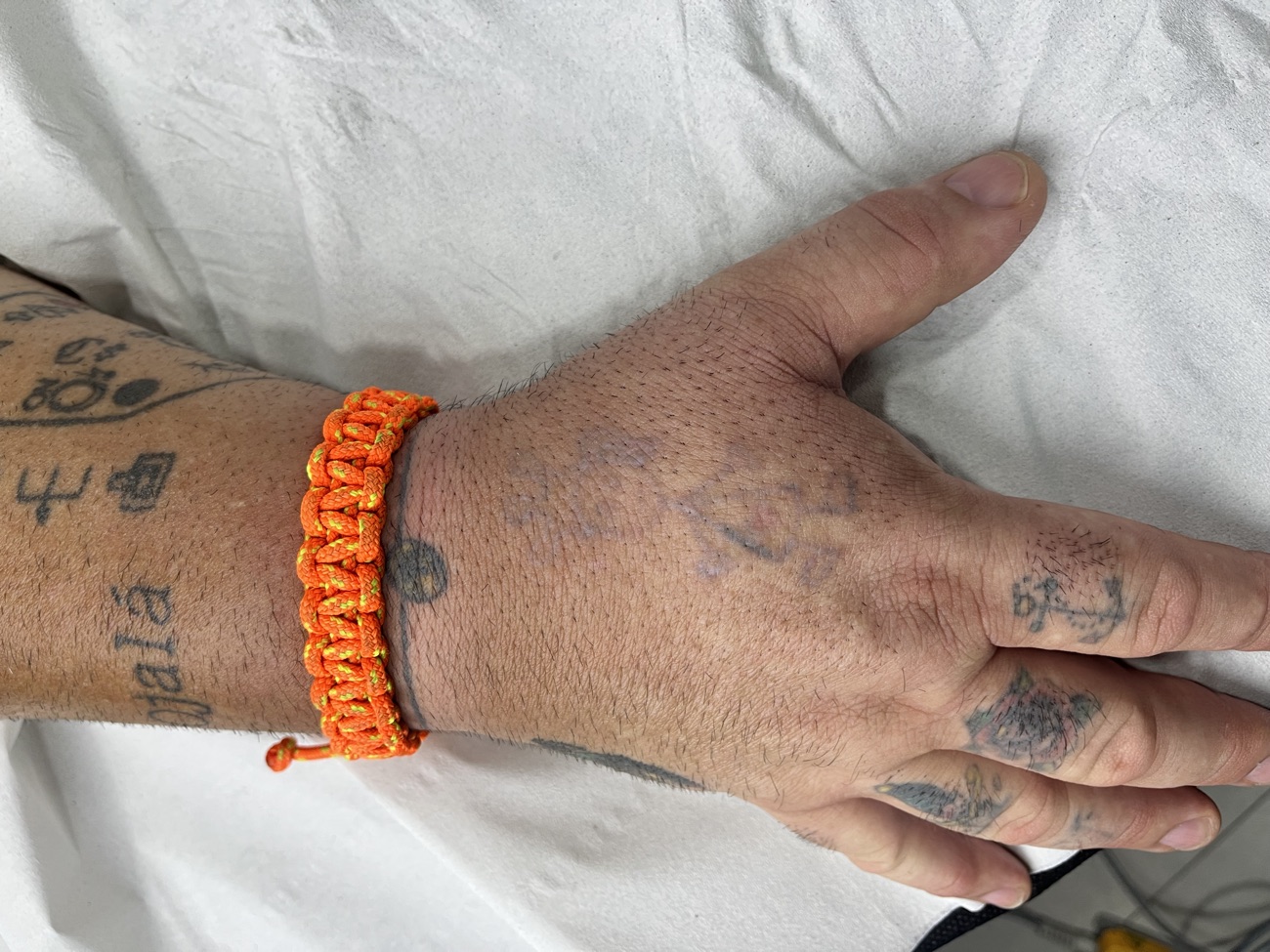 Resultado tras la eliminación láser del tatuaje